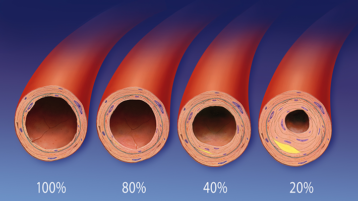 Arteriosklerose